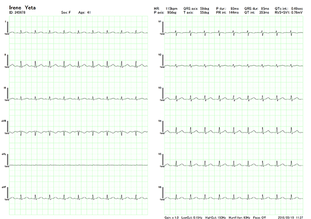 12-Lead ECG